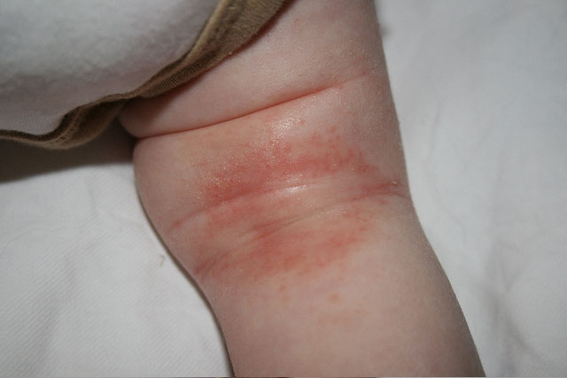 heat rash on toddlers - pictures, photos