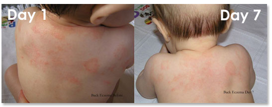 natural child baby eczema treatment