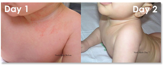 natural child baby eczema treatment