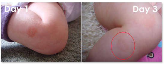 natural child baby eczema treatment